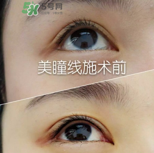 做美瞳線可以吃雞蛋嗎？做美瞳線能吃雞蛋嗎？