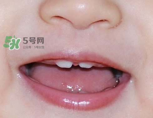 牙齒縫隙大怎么辦？牙縫大帶牙套有用嗎