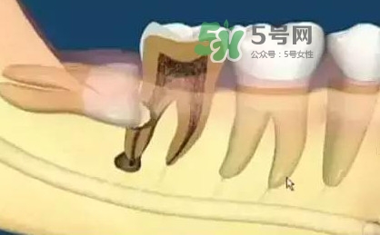 智齒是每個(gè)人都會(huì)長(zhǎng)嗎？拔智齒能瘦臉嗎？