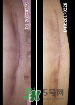 Biodermis百德絲疤痕貼有效嗎？Biodermis百德絲疤痕貼好用嗎？