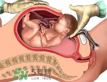 剖腹產(chǎn)比順產(chǎn)安全嗎？剖腹產(chǎn)產(chǎn)后注意事項(xiàng)？