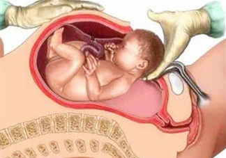 剖腹產(chǎn)比順產(chǎn)安全嗎？剖腹產(chǎn)產(chǎn)后注意事項(xiàng)？