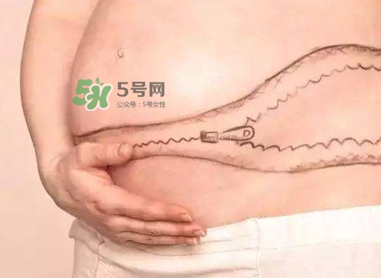 剖腹產(chǎn)疤痕怎么去除？剖腹產(chǎn)疤痕能去掉嗎？