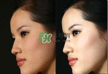 美白針有副作用嗎？美白針有什么副作用？