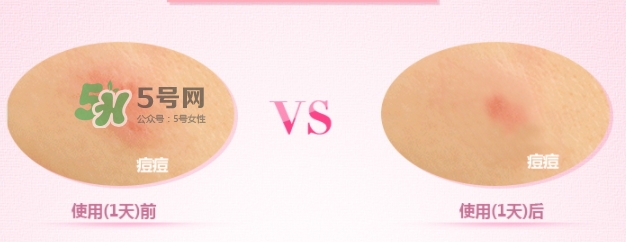 3m痘痘貼怎么用？3m痘痘貼貼多久？