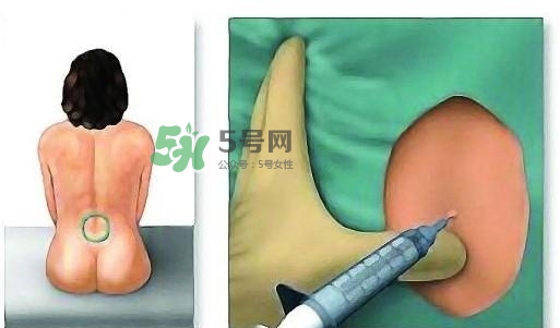 無痛分娩為什么不提倡？無痛分娩有后遺癥嗎？