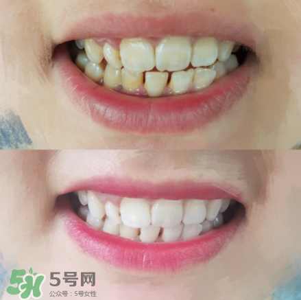 碧緹福美牙儀好用嗎？碧緹福美牙儀原理