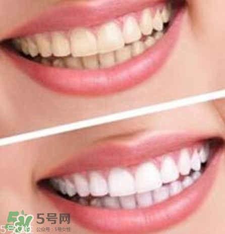 碧緹福美牙儀對牙齒有傷害嗎？碧緹福美牙儀會反彈嗎？