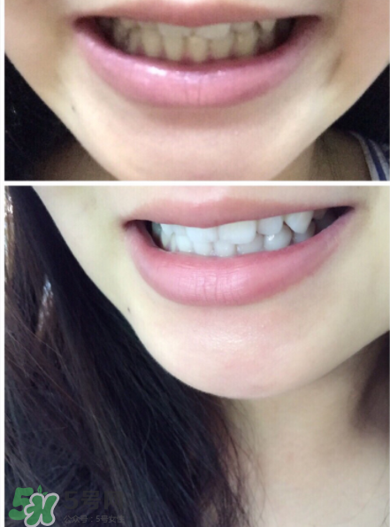 美牙儀能用水洗嗎？美牙儀能用多久？