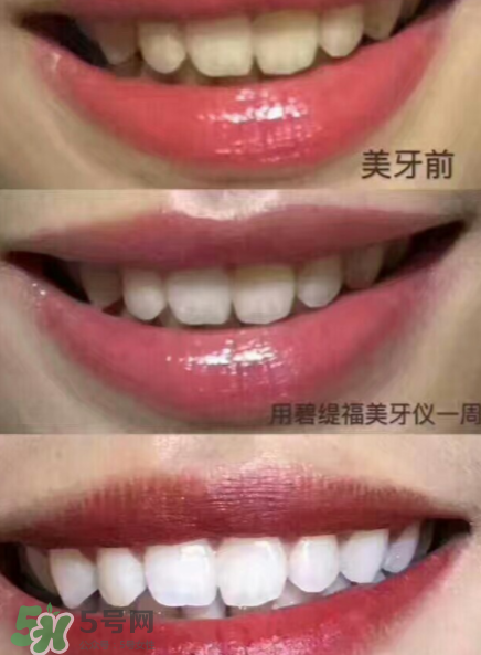 美牙儀能用水洗嗎？美牙儀能用多久？