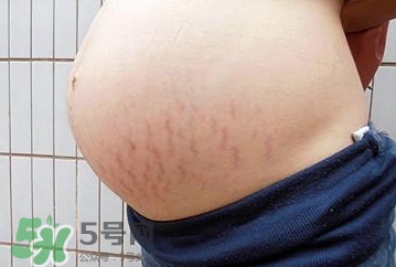 妊娠紋什么時候開始預(yù)防？妊娠紋什么時候消除？