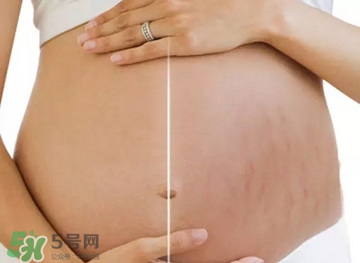 脖子上會(huì)長(zhǎng)妊娠紋嗎？妊娠紋長(zhǎng)在哪些地方？