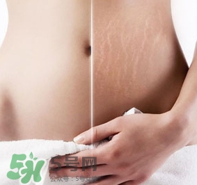 妊娠紋什么時候變白？妊娠紋產(chǎn)品什么時候用？