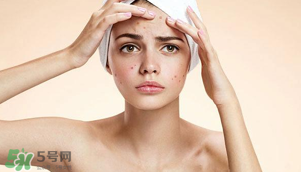 長(zhǎng)痘長(zhǎng)閉口怎么辦？長(zhǎng)痘長(zhǎng)閉口是什么原因？