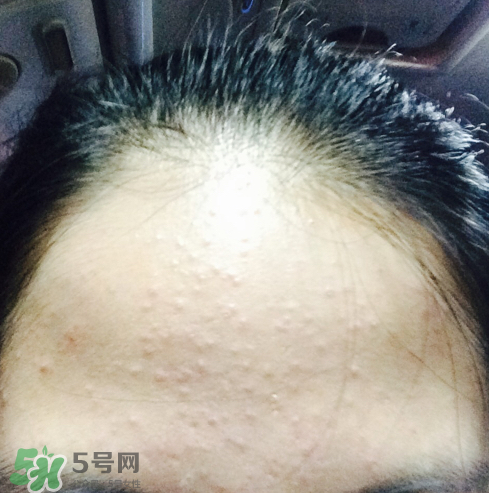 長(zhǎng)痘長(zhǎng)閉口怎么辦？長(zhǎng)痘長(zhǎng)閉口是什么原因？