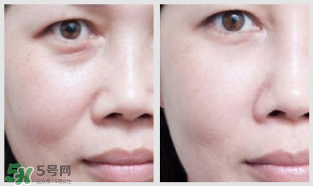 法令紋怎么消除？如何正確對待法令紋？