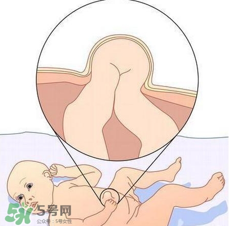 臍疝是什么？臍疝對寶寶有什么影響？