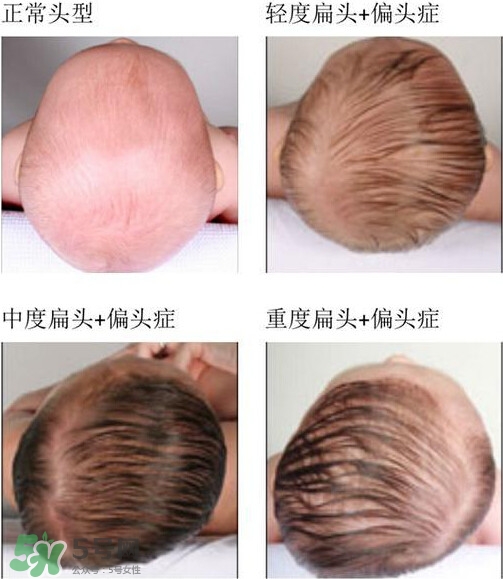 寶寶頭型是睡出來的嗎？寶寶頭型矯正最佳時(shí)間