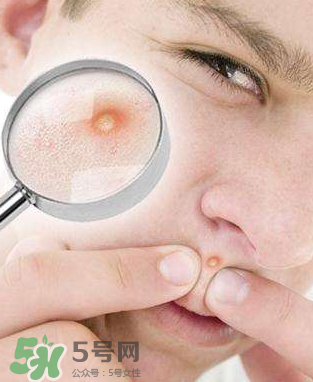 痘痘是如何形成的？食物祛痘法