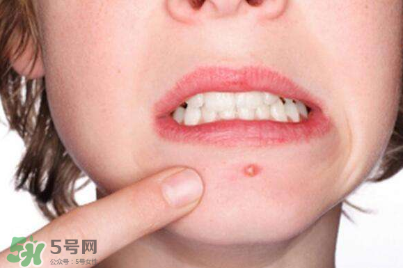 暗瘡可以擠壓嗎？油性和骯臟肌膚會(huì)容易有暗瘡嗎？