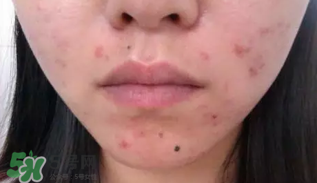 痤瘡和毛囊炎一樣嗎？痤瘡與毛囊炎區(qū)別