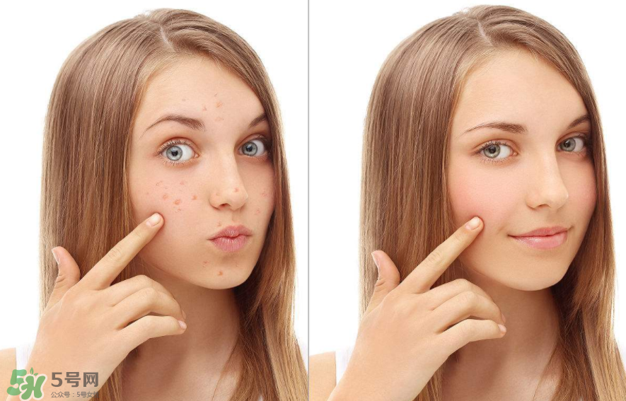 痤瘡和毛囊炎一樣嗎？痤瘡與毛囊炎區(qū)別