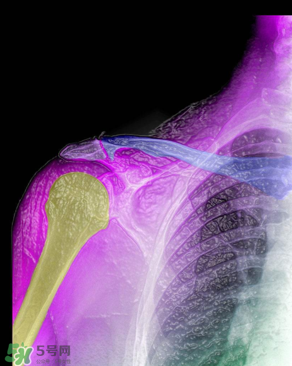 骨刺是怎么形成的？骨刺怎么治療？