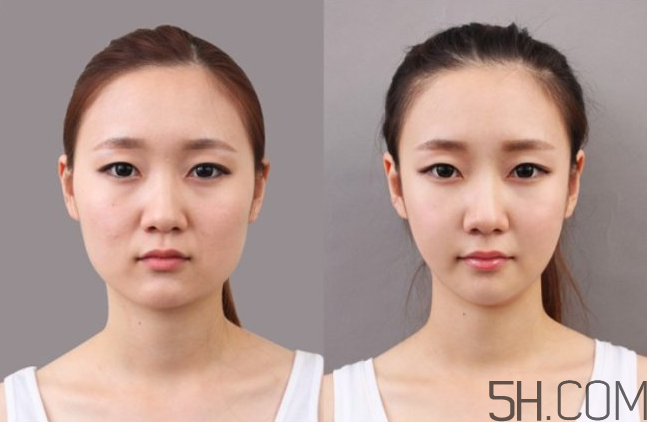 瘦臉針有依賴嗎？打瘦臉針有依賴性嗎？