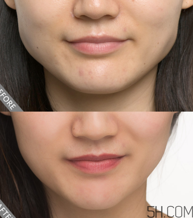 瘦臉針需要打幾次有效？瘦臉針需要打幾次定型？