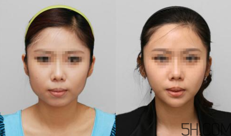 瘦臉針要做皮試嗎？瘦臉針皮試怎么做？