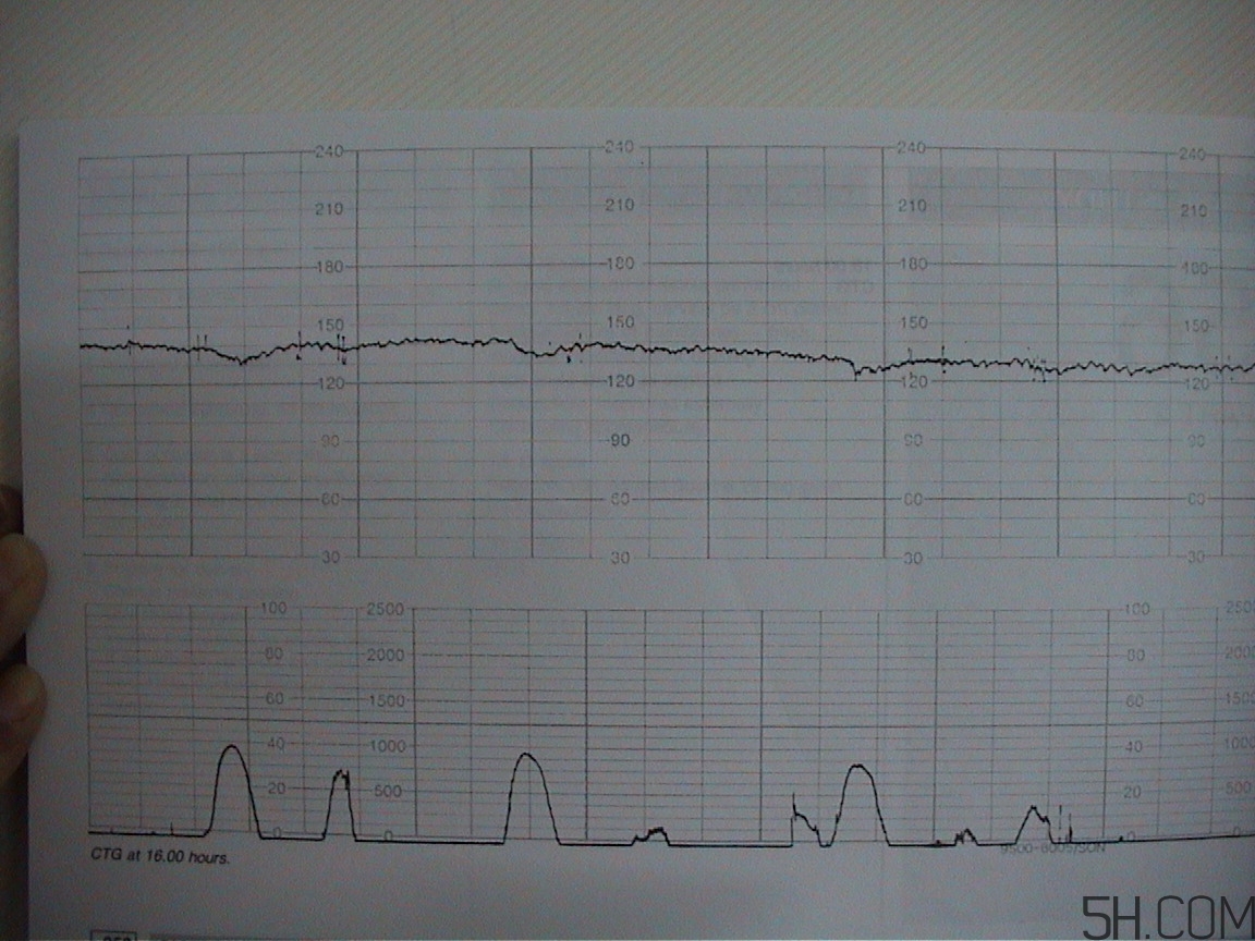 為什么要做胎心監(jiān)護(hù)？孕婦做胎心監(jiān)護(hù)有什么用？