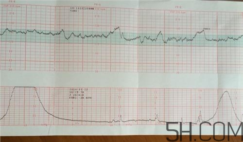 為什么要做胎心監(jiān)護(hù)？孕婦做胎心監(jiān)護(hù)有什么用？