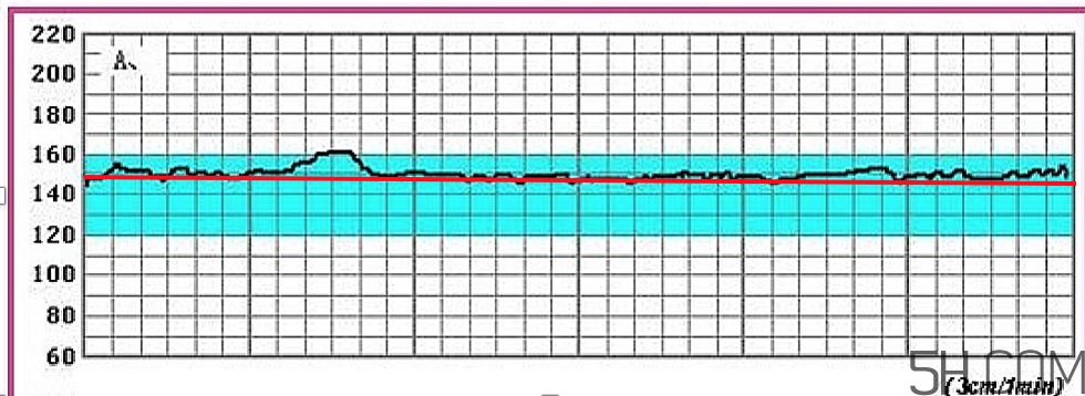 為什么要做胎心監(jiān)護(hù)？孕婦做胎心監(jiān)護(hù)有什么用？