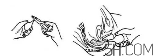 用開塞露會拉稀嗎？便秘用開塞露不管用怎么辦？