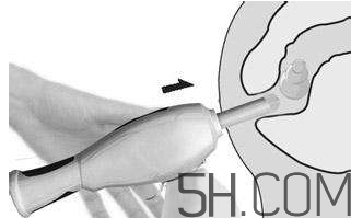 開塞露怎么用？開塞露用后多久會排便？