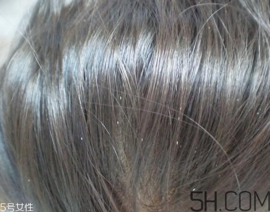 頭虱和頭皮屑怎么區(qū)分？頭虱是怎樣生成的