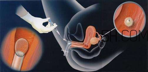 人工授精取卵子怎么??？人工授精男人怎樣取精？