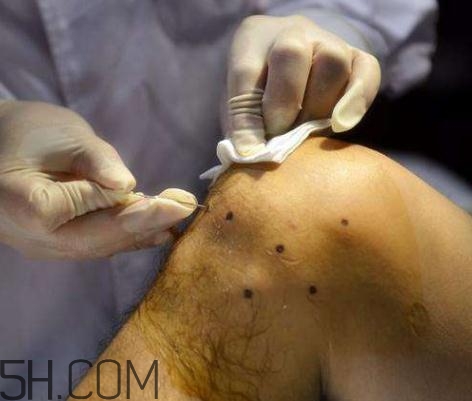 關(guān)節(jié)炎積液什么癥狀？關(guān)節(jié)炎積水怎么治療？