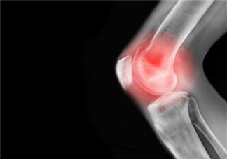 關(guān)節(jié)炎需要補(bǔ)鈣嗎？關(guān)節(jié)炎補(bǔ)鈣有用嗎？
