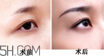 切眉手術(shù)后老得快嗎？切眉能保持多久？