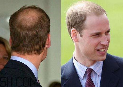 什么樣的人容易禿頂？為什么女人不禿頂