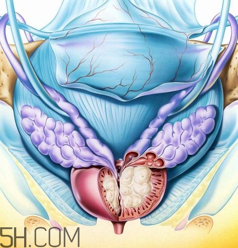 前列腺增生會(huì)不會(huì)癌變？前列腺增生能徹底治愈嗎？