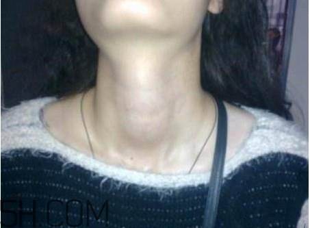 甲狀腺結(jié)節(jié)掛什么科？甲狀腺結(jié)節(jié)可以懷孕嗎