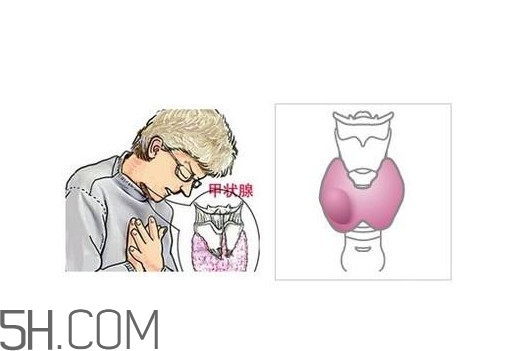 為什么會(huì)得甲狀腺結(jié)節(jié)？甲狀腺節(jié)結(jié)是什么？
