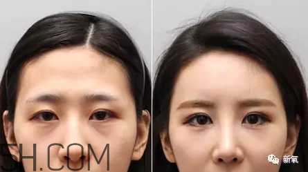 黑眼圈怎么去除既簡單有容易 看類型與程度 黑眼圈怎么去除既簡單有容易 看類型與程度