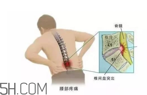 腰間盤(pán)突出是什么原因引起的？腰間盤(pán)突出是腎虛嗎