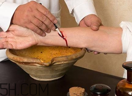 放血療法適合任何人嗎？放血療法是如何退出歷史舞臺的