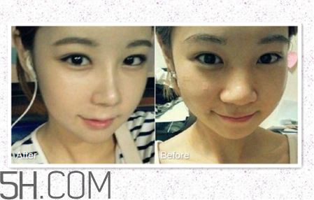 鼻頭縮小術(shù)過程圖 鼻頭縮小手術(shù)千萬別做后悔死