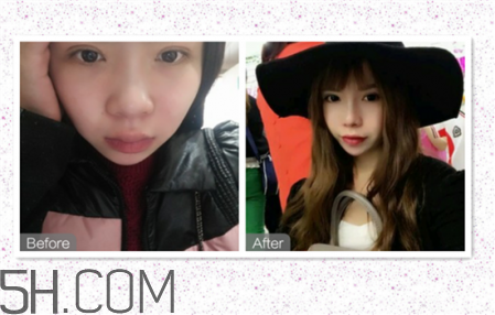 鼻頭縮小術(shù)過程圖 鼻頭縮小手術(shù)千萬別做后悔死