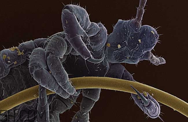 孩子長虱子是怎么回事？孩子長虱子該怎么辦？